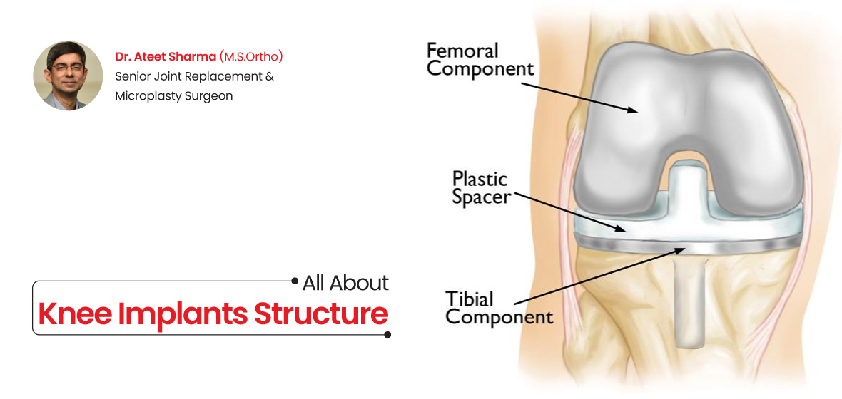 all about knee implants structure