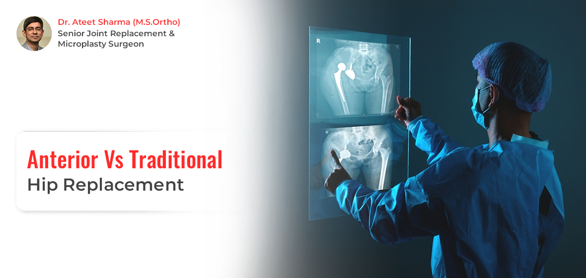 Anterior vs traditional hip replacement