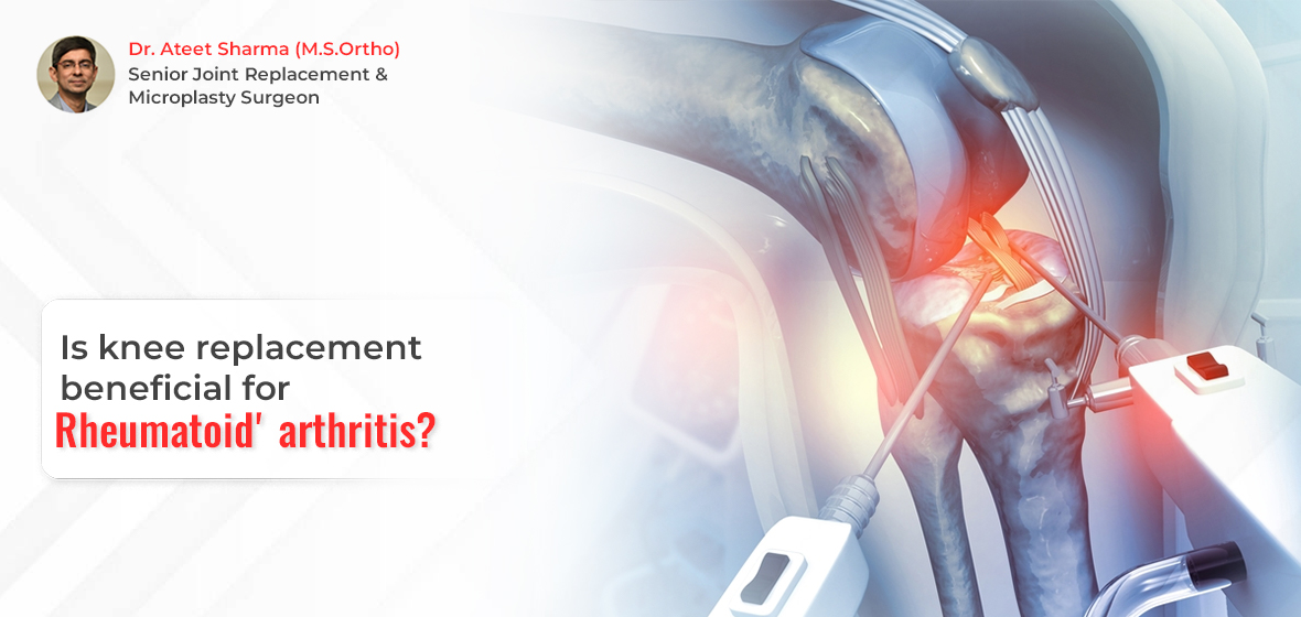 Knee replacement beneficial for rheumatoid arthritis