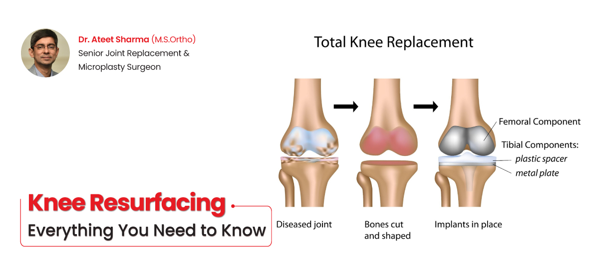 knee resurfacing