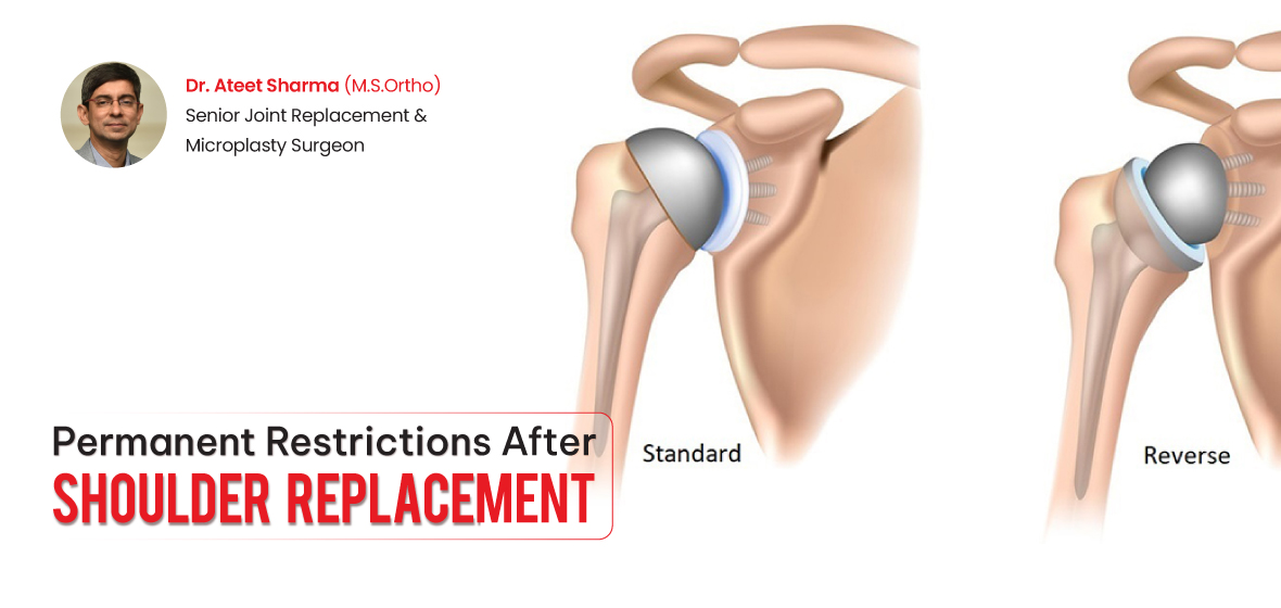 Permanent Restrictions After Shoulder Replacement