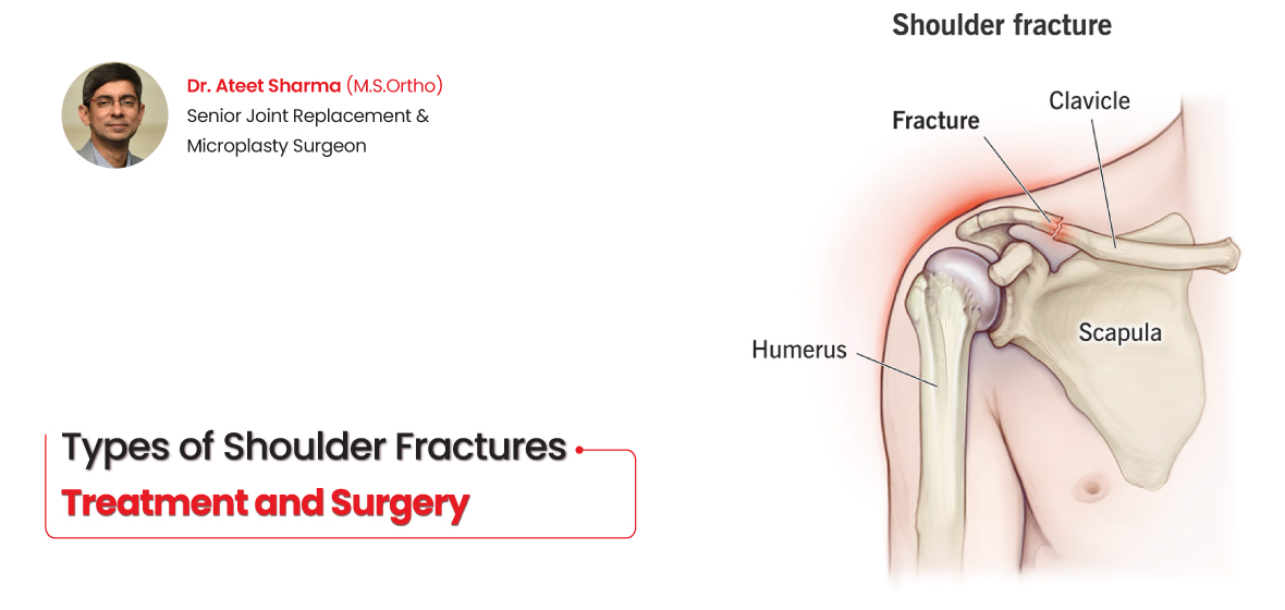 Types of shoulder fractures