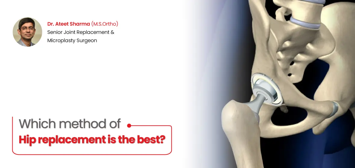 Which Method of Hip Replacement is the Best