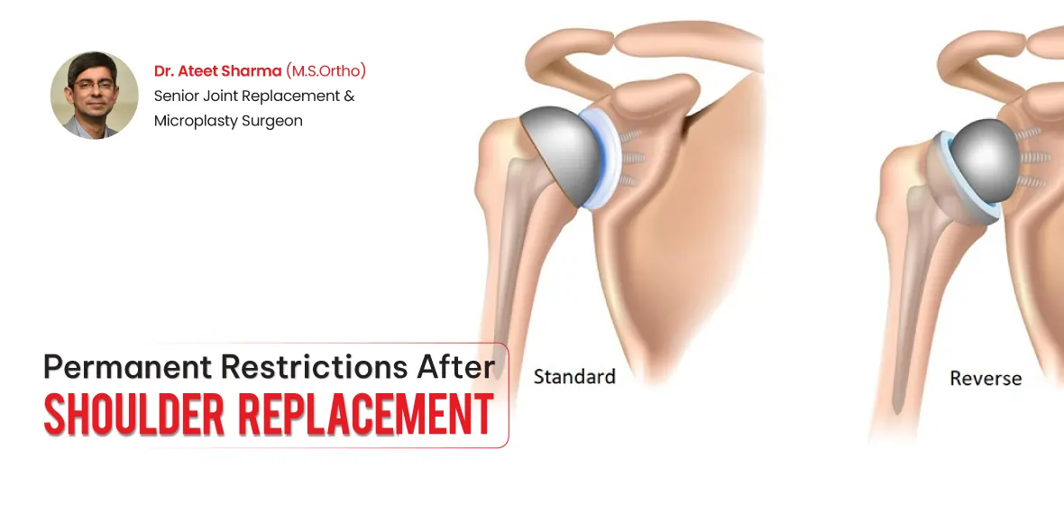 Shoulder Replacement
