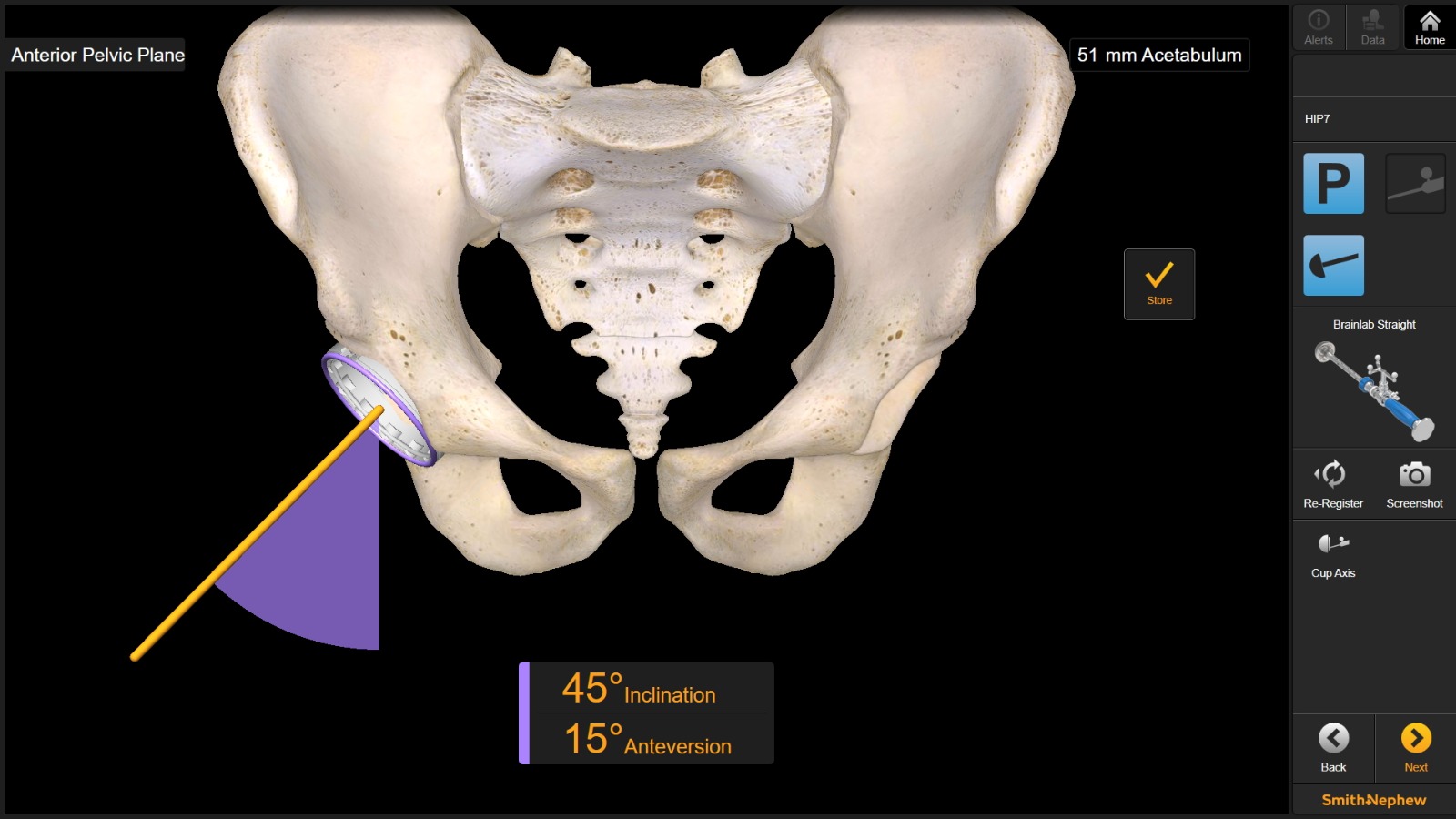 Anterior Approach to Hip Replacement