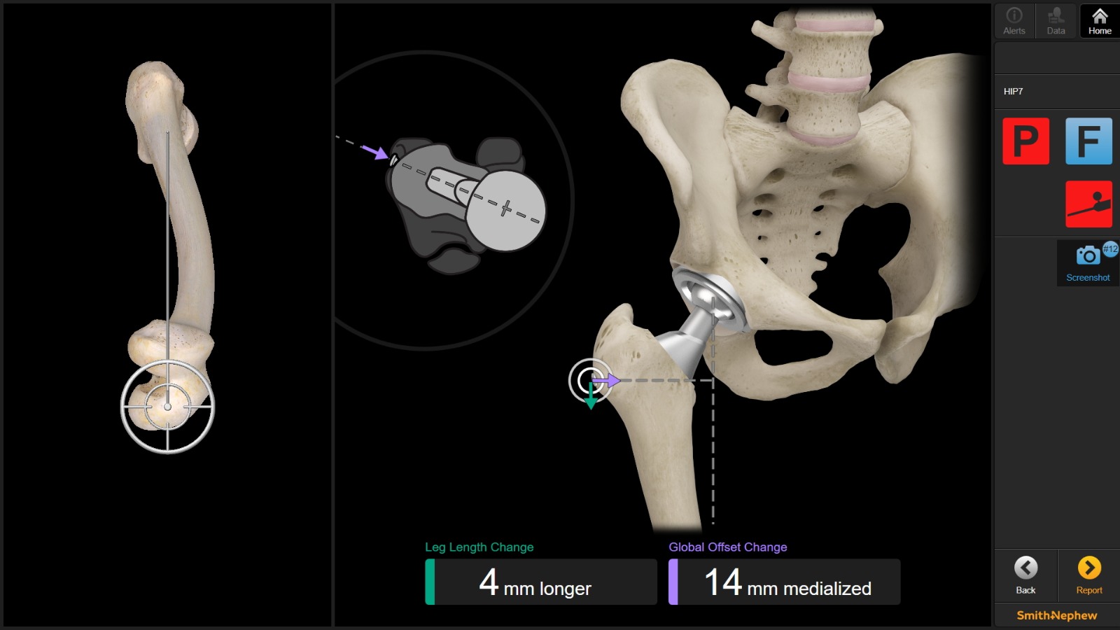 Anterior Approach to Hip Replacement